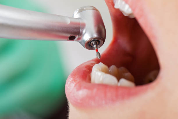 Best Emergency Tooth Extraction in South Kensington, MD